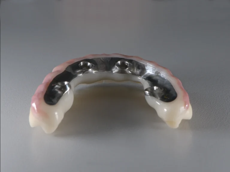 All-on-4 Vollbogen mit verschraubter Titanbasis und ästhetischer Zahnfleischgestaltung