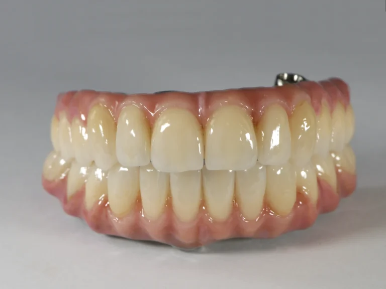 Implantatgetragene, verschraubte Vollprothese mit charakterisierter Gingiva und metallverstärkter Struktur